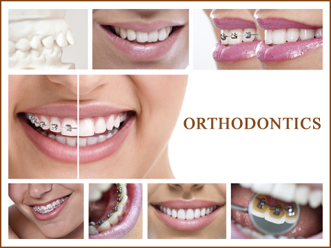 Orthodontic Functional Appliances