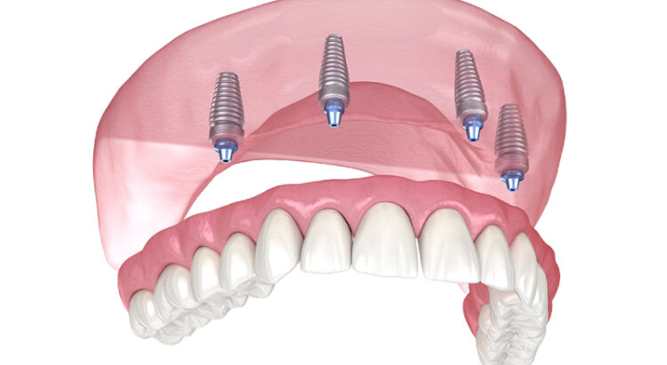 affordable dentures