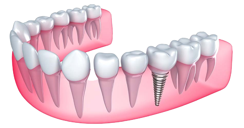 affordable dentures